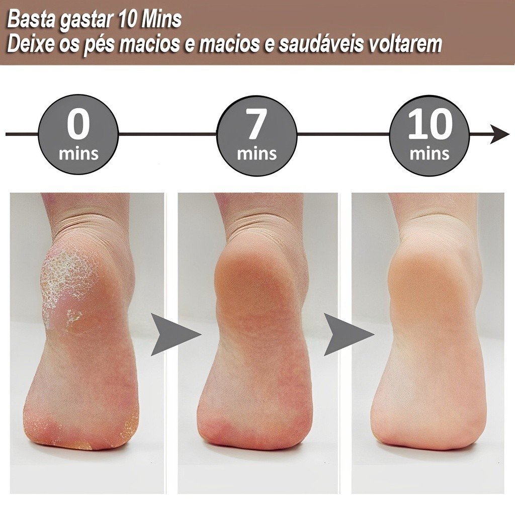 Lixador Pé Elétrico Esfoliador Tira Calos Pedicure Portátil Lixa Podologa Spa dos Pes Elimina Calosidade e Rachadura Usb